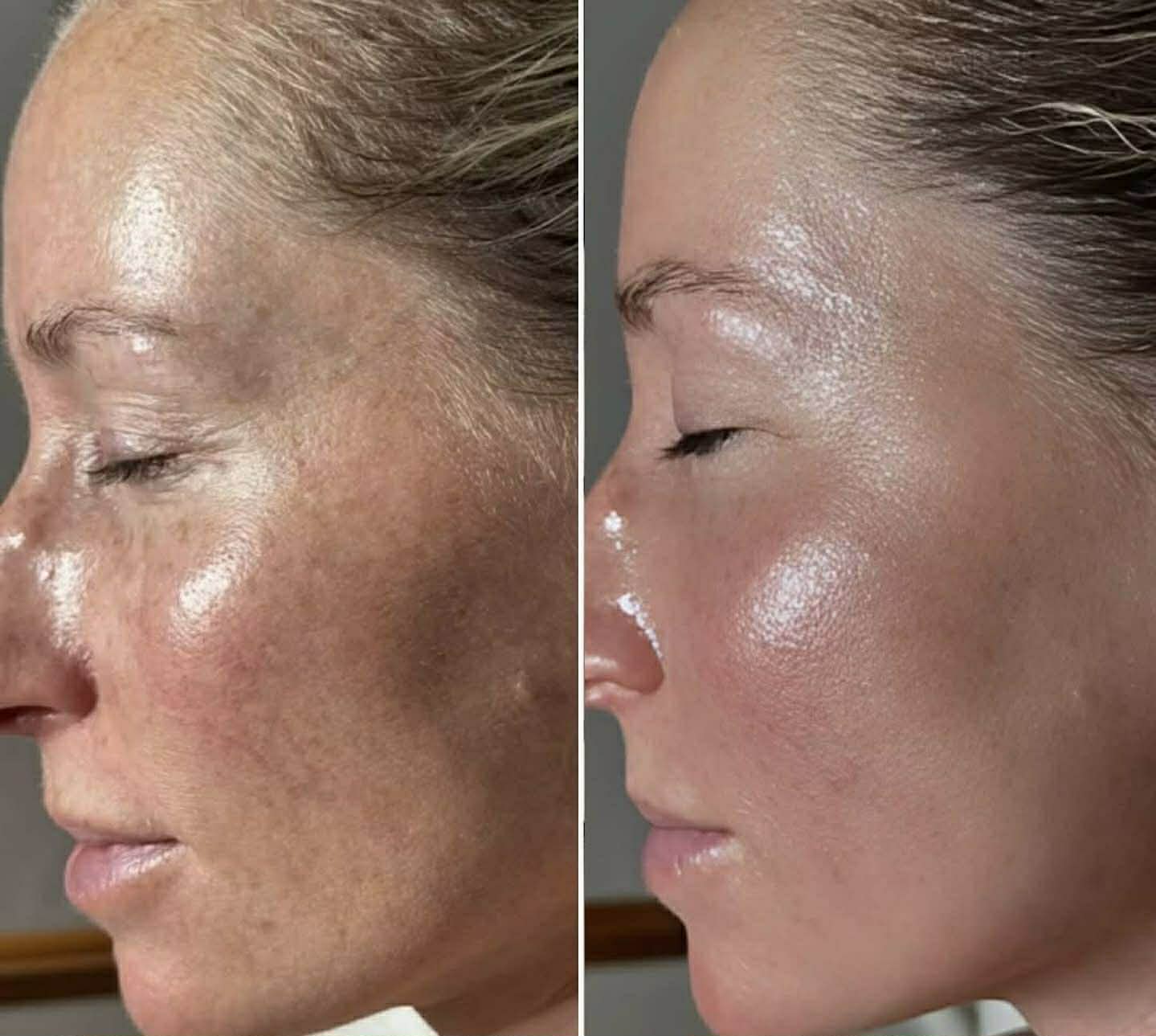 RF Lifting — immediately after