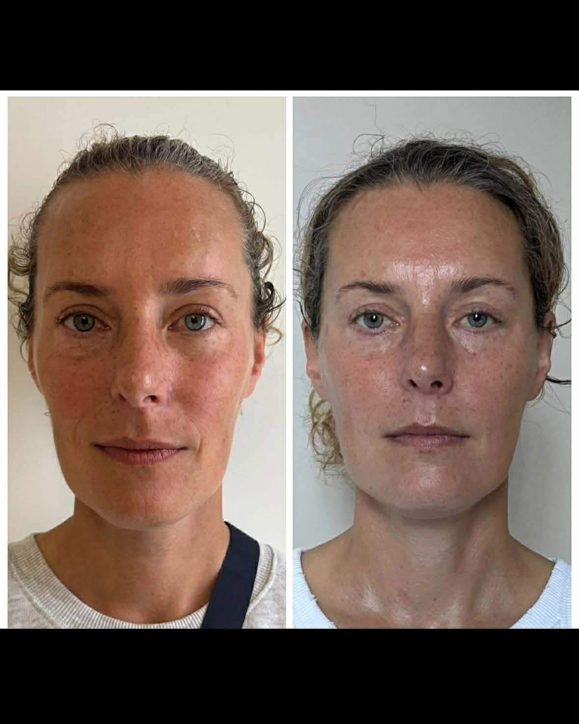 RF Lifting — after treatment