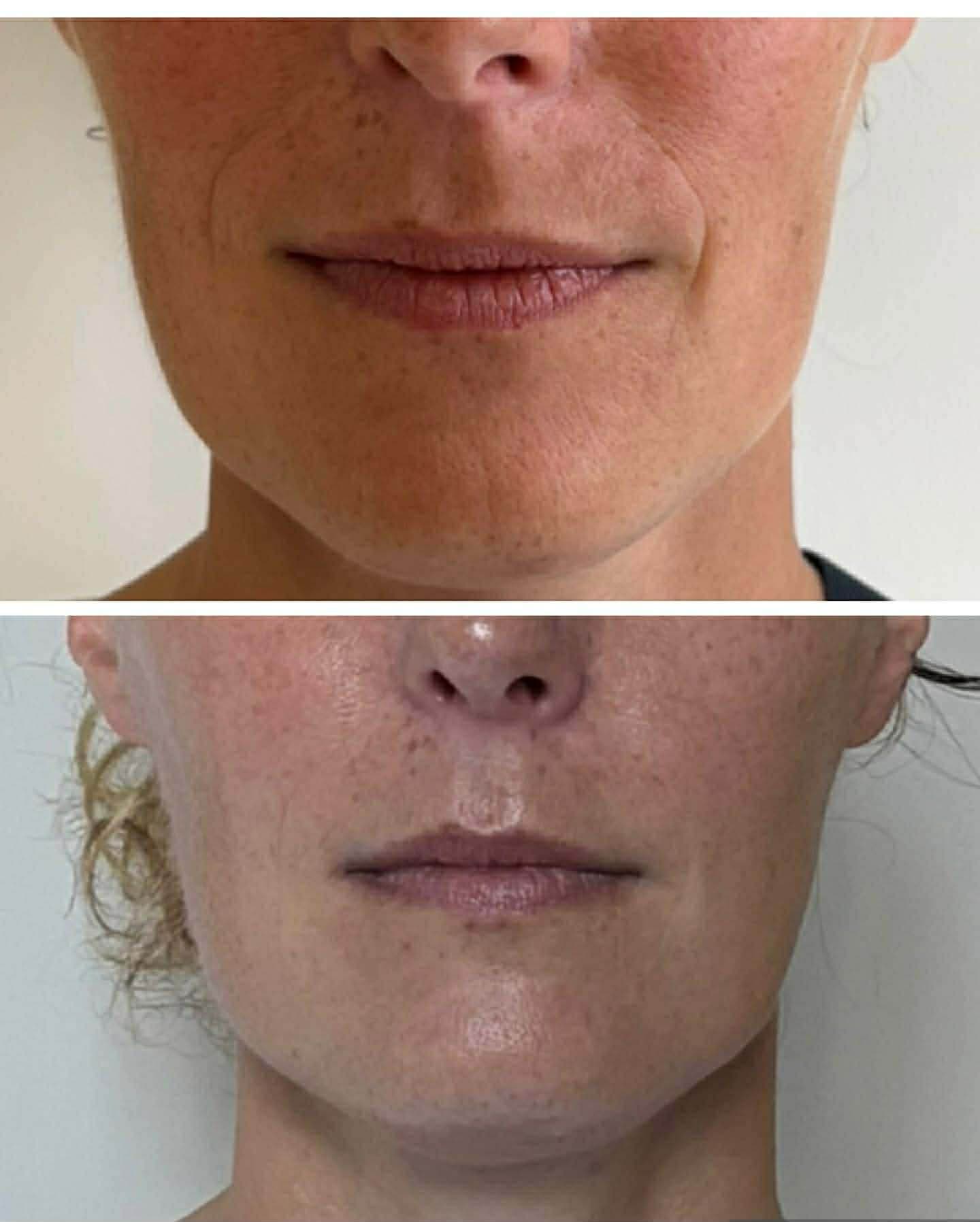 RF Lifting — skin glow after