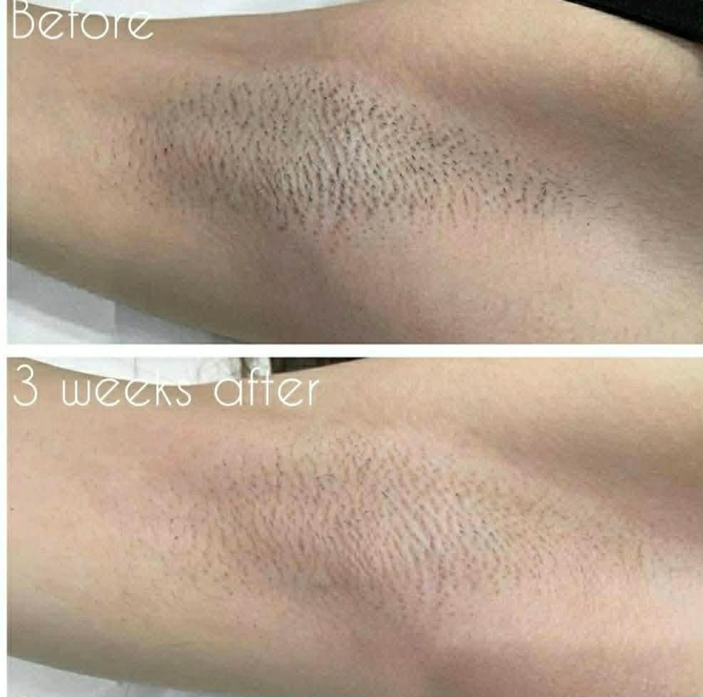 Laser hair removal — armpit before & after