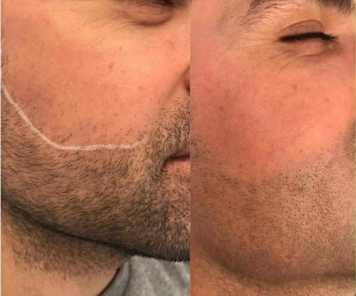 Laser hair removal — before & after back