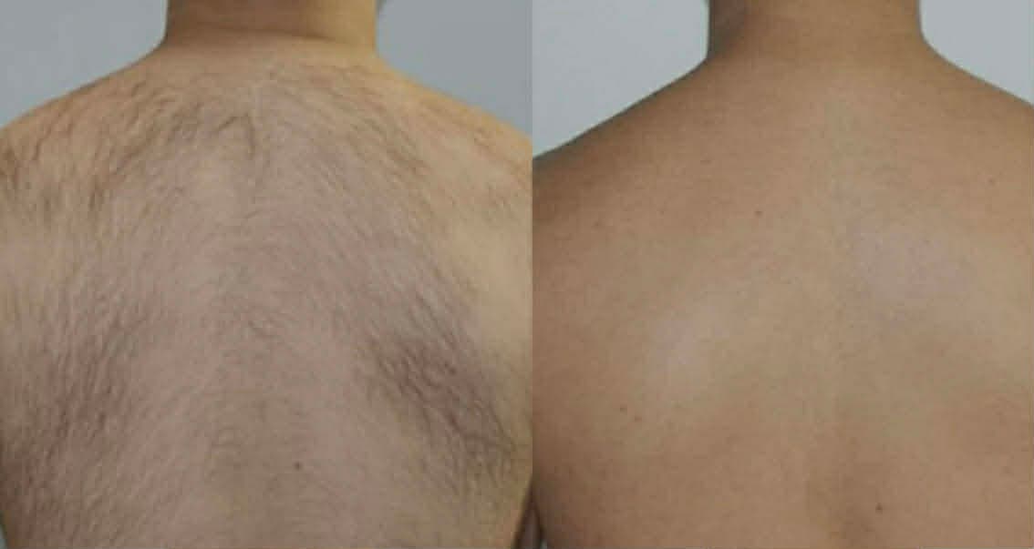 Laser hair removal — before & after face