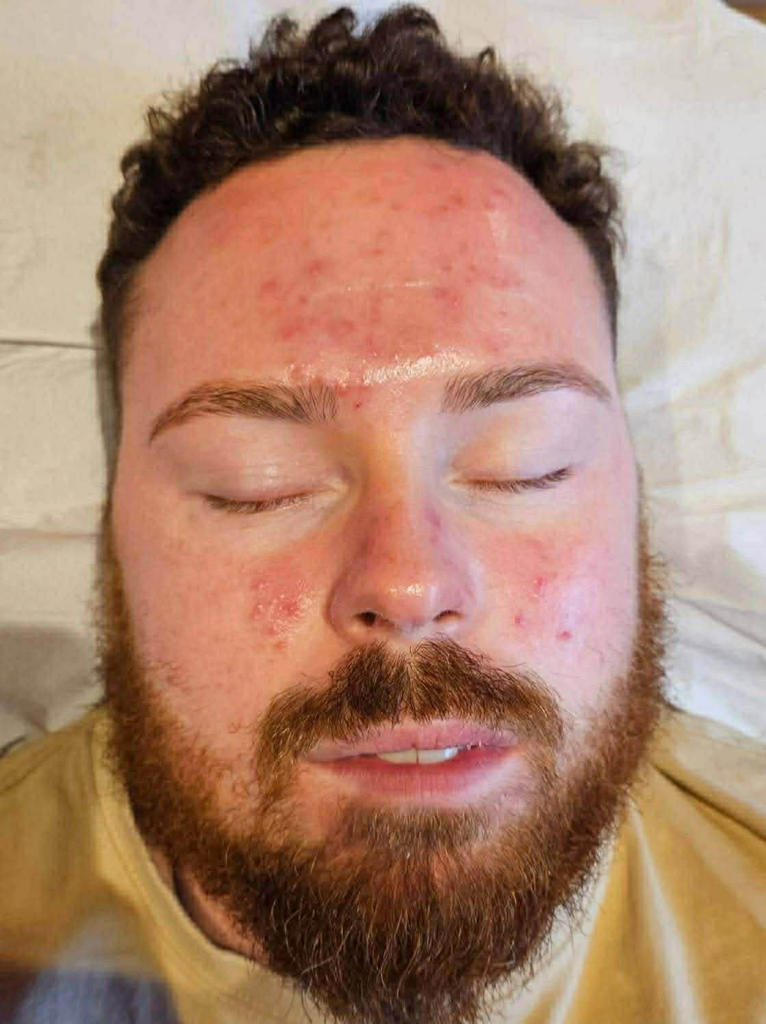 Skin base treatment — after